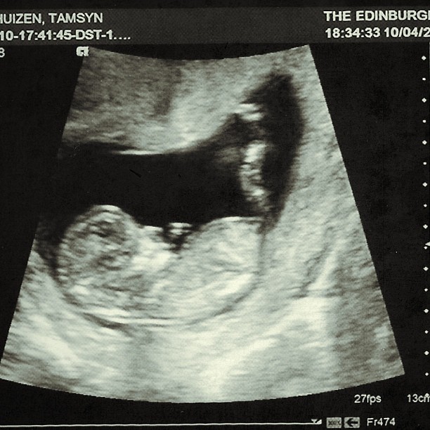 Ultrasound scan showing a side view of a fetus curled inside the womb, with medical text and measurements around the border.