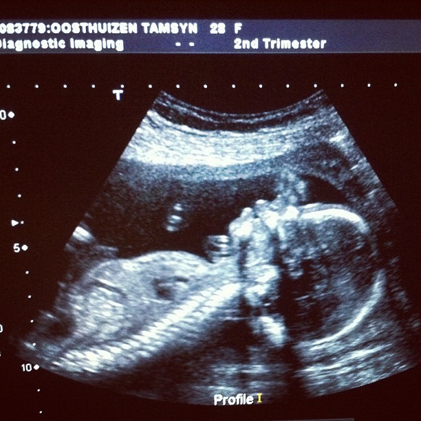 Ultrasound screen showing a side profile of a fetus with the head on the right and curved spine visible.