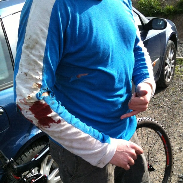 Person in a blue shirt with a torn, dirt-stained white sleeve and a large bloodstain on the arm, standing beside a car and bicycle.