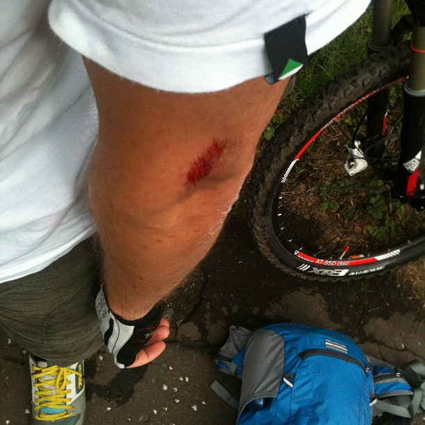 Person’s scraped elbow with a bleeding abrasion beside a mountain bike wheel and blue backpack on pavement.